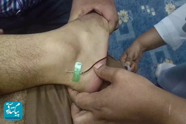 مقایسه فصد عرق‌ النسا و دیکلوفناک در کاهش دردهای انتشار یافته به اندام‌ تحتانی