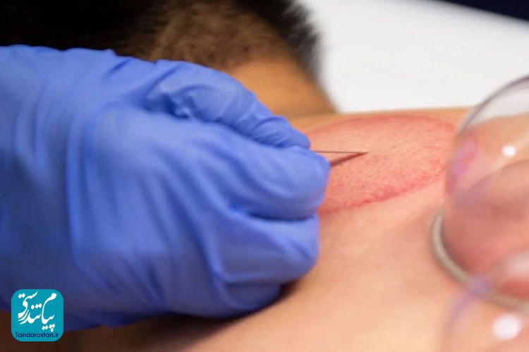 در چه شرایطی حجامت ممنوع است؟