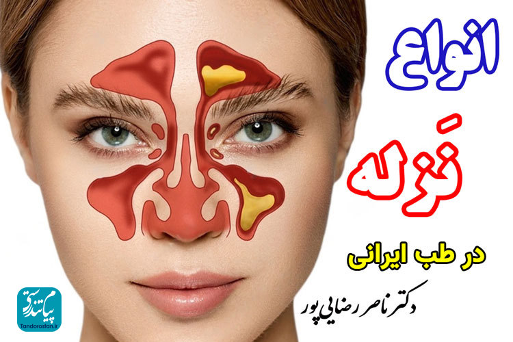 آشنایی با انواع نزله در طب ایرانی