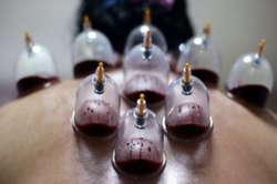 آیا حجامت تر بین کتف‌ ها (حجامت عام) موجب بهبود افسردگی و اضطراب میشود؟