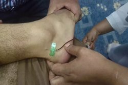 مقایسه فصد عرق‌ النسا و دیکلوفناک در کاهش دردهای انتشار یافته به اندام‌ تحتانی