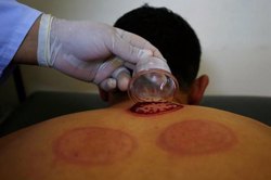 بهترین زمان مناسب انجام حجامت