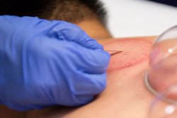 در چه شرایطی حجامت ممنوع است؟