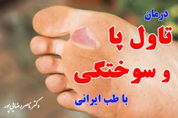 راههای درمان تاول پا و سوختگی از زبان پزشک متخصص طب ایرانی