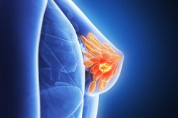 پیشگیری از سرطان سینه (پستان) به روش طب سنتی ایرانی [راهکار های طبیعی+علائم+درمان]